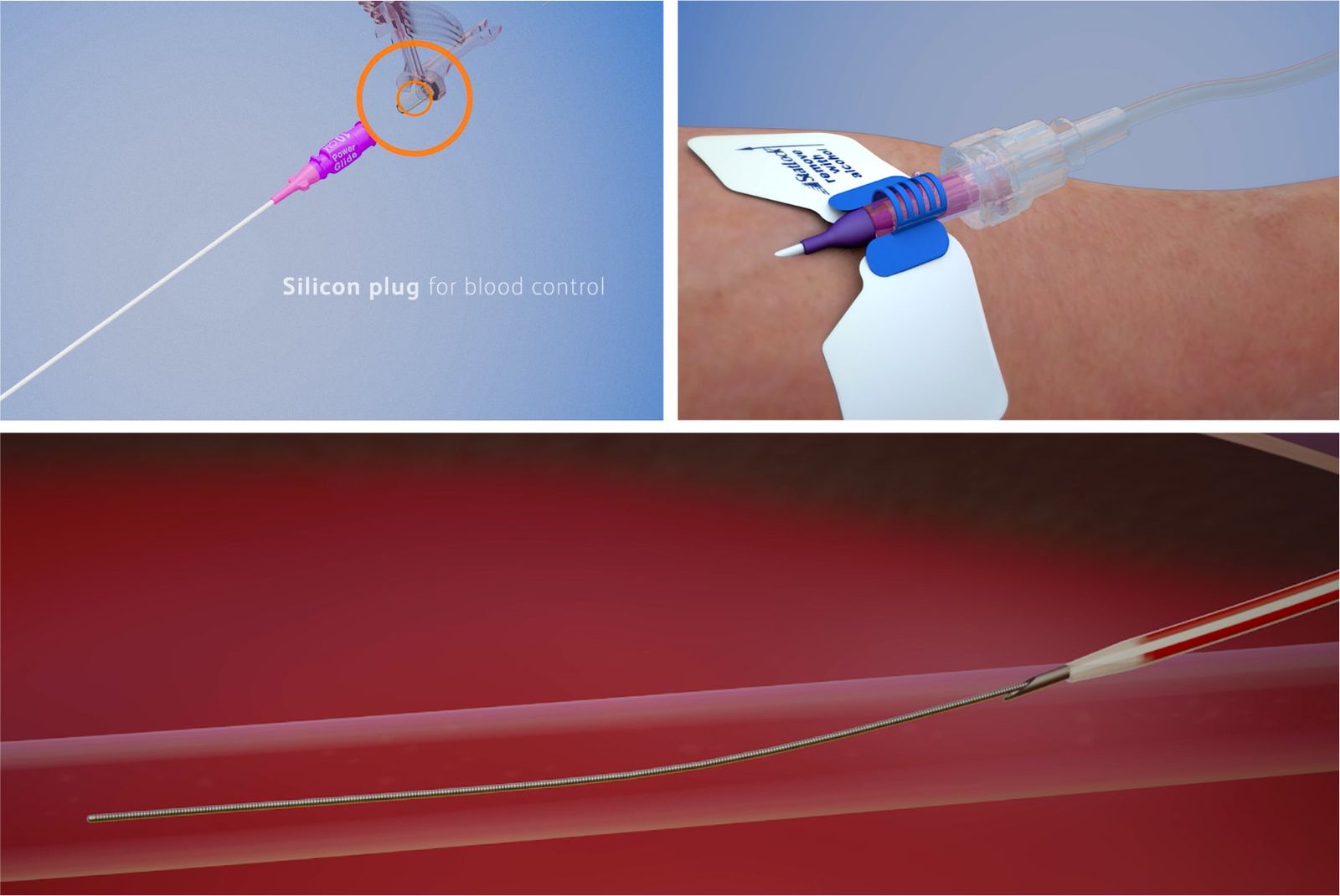 Difficult IV Access for Becton, Dickinson and Company